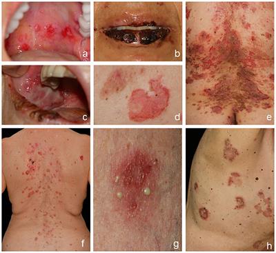 State-of-the-art diagnosis of autoimmune blistering diseases